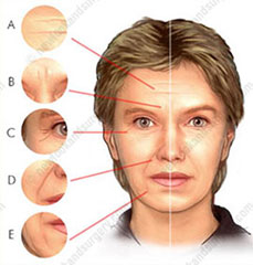 Facial-wrinkles
